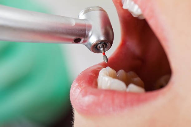Best Emergency Wisdom Teeth Removal in Bear Creek Ranch, TX
